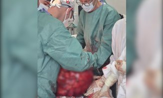 Intervenție spectaculoasă la SCJU Cluj! O echipă de chirurgi a îndepărtat o tumoră de 25 kg într-o operație de mare risc