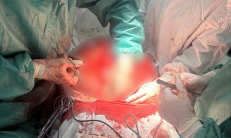 Intervenție spectaculoasă la SCJU Cluj! O echipă de chirurgi a îndepărtat o tumoră de 25 kg într-o operație de mare risc