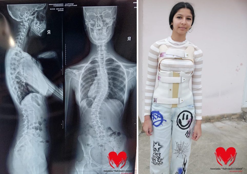 „Fiecare zi îmi curbează coloana tot mai mult”. Erika, o adolescentă de 15 ani, are nevoie urgent de o operație pentru a putea trăi fără durere