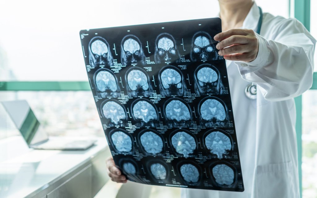 Avans în lupta cu Alzheimer. Israelul a dezvoltat o tehnologie care detectează boala cu ani înainte de primele simptome