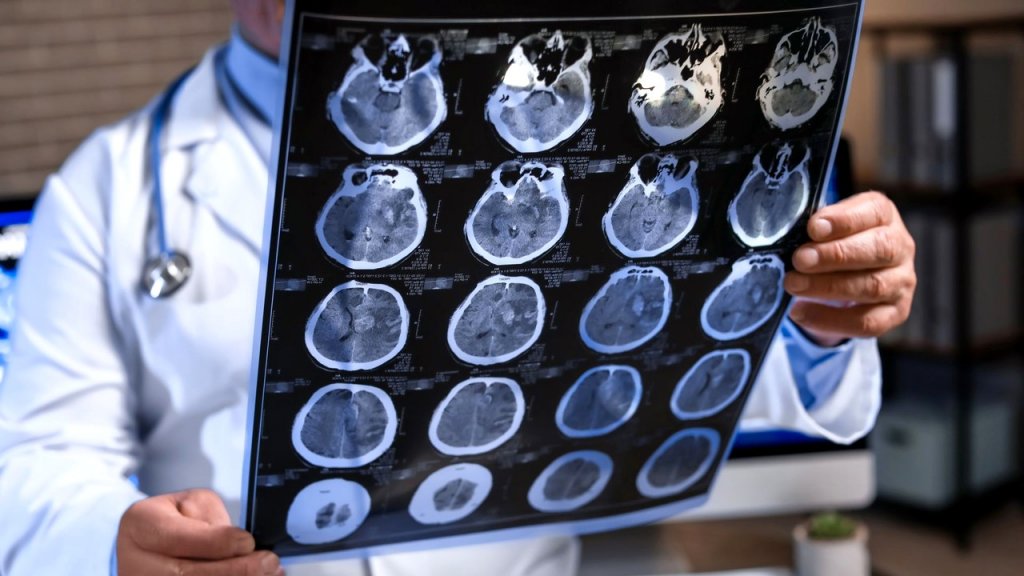 Densitatea osoasă scăzută, legată de declinul cognitiv. Ce au descoperit cercetătorii