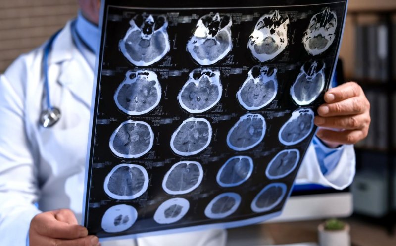 Densitatea osoasă scăzută, legată de declinul cognitiv. Ce au descoperit cercetătorii